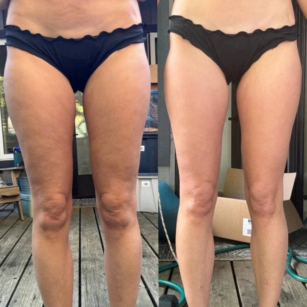 Boutily™ - Anti-Cellulite Massager